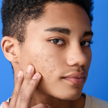 African american Teenager Boy With Acne Problem On,Color,Background