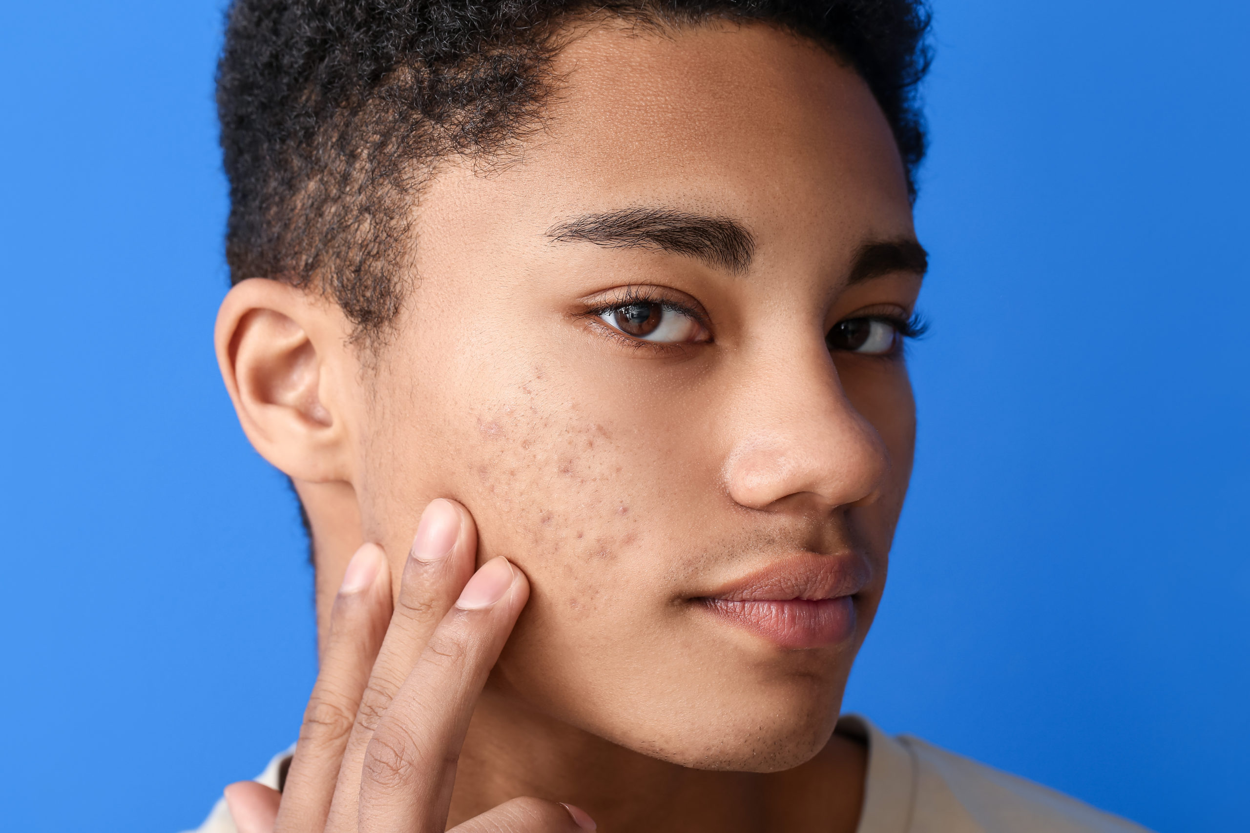 African american Teenager Boy With Acne Problem On,Color,Background